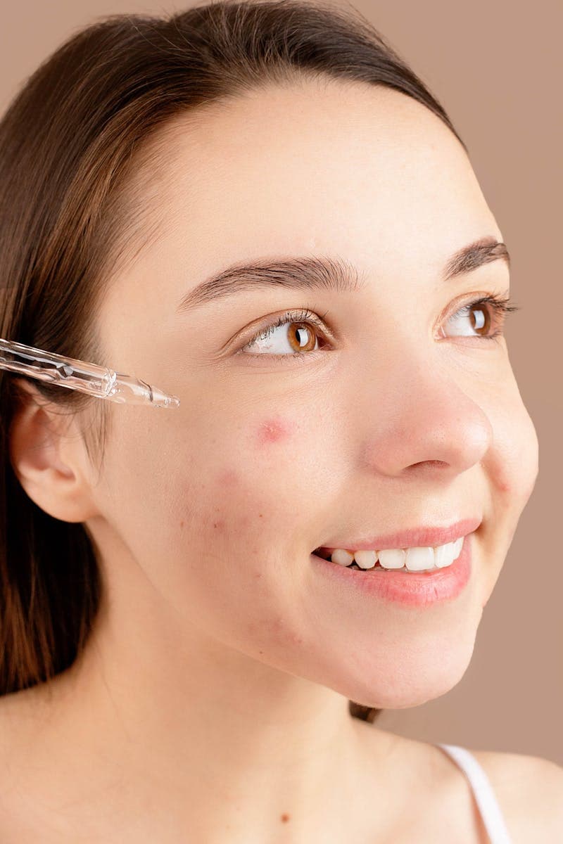 Woman applying acne treatment serum on face — can you get microneedling with active acne guide